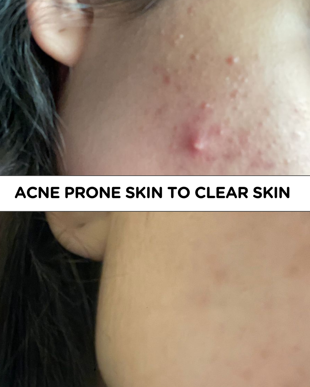 Customer-submitted before-and-after comparison of acne-prone skin appearance.