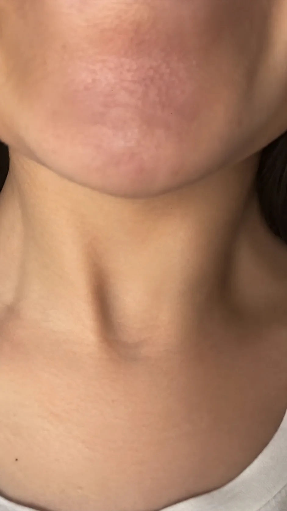 Customer-submitted after view of chin skin appearance.