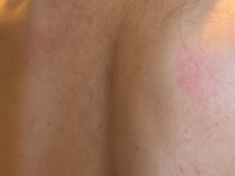 Customer-submitted before view of upper-back skin appearance.