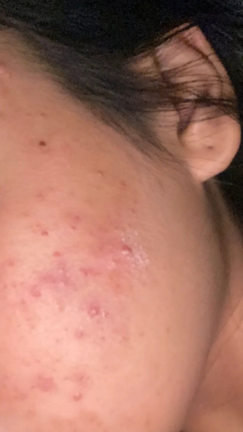 Customer-submitted before view of cheek skin appearance.