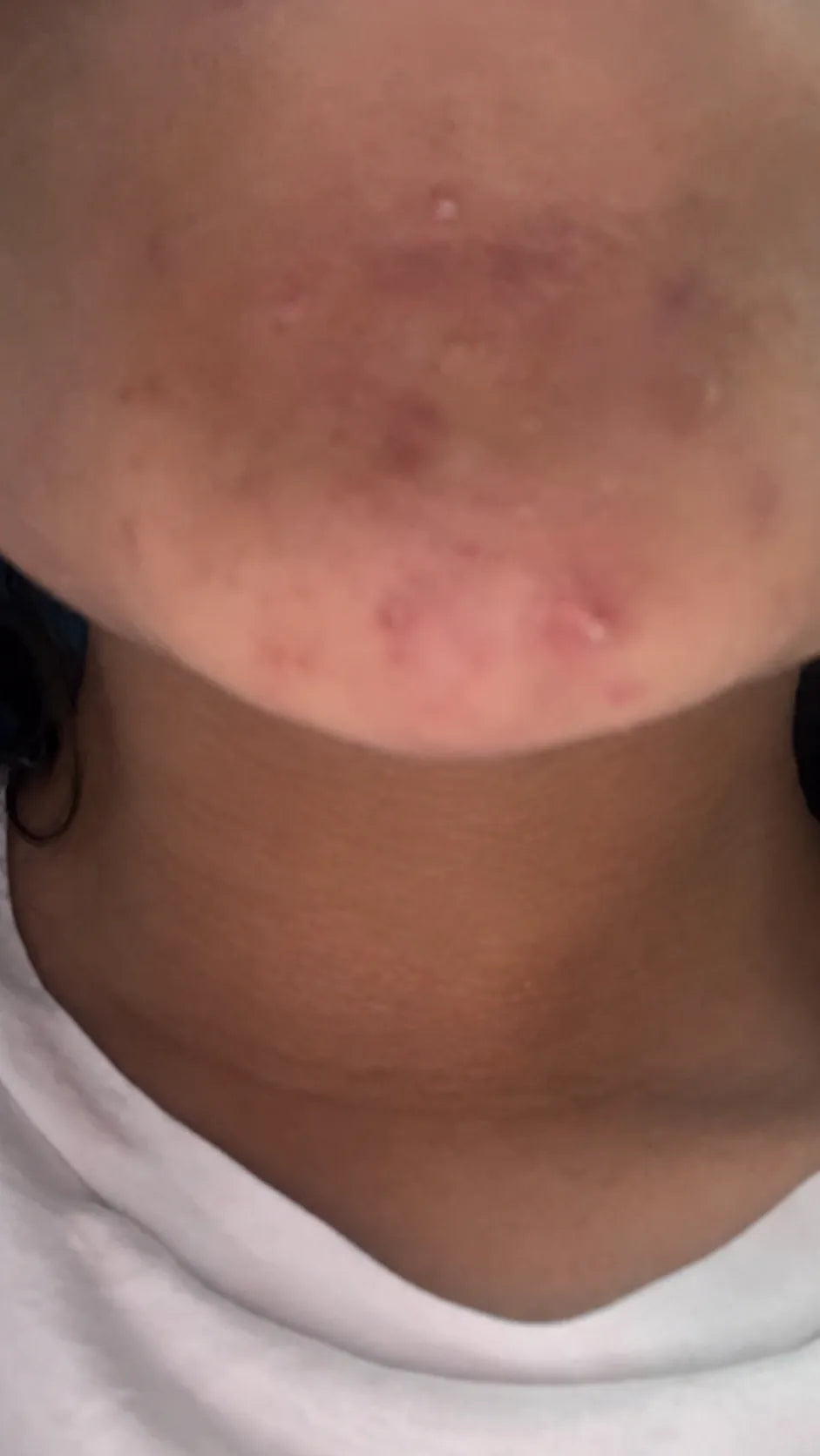 Customer-submitted before view of chin skin appearance.