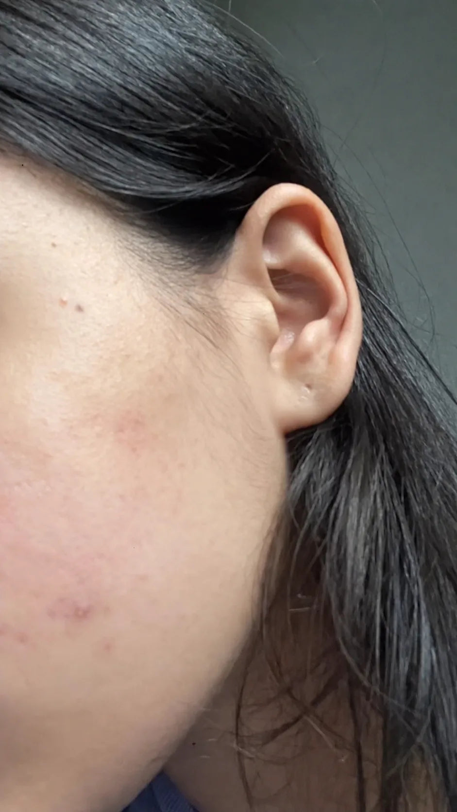 User-submitted after view of cheek skin appearance.
