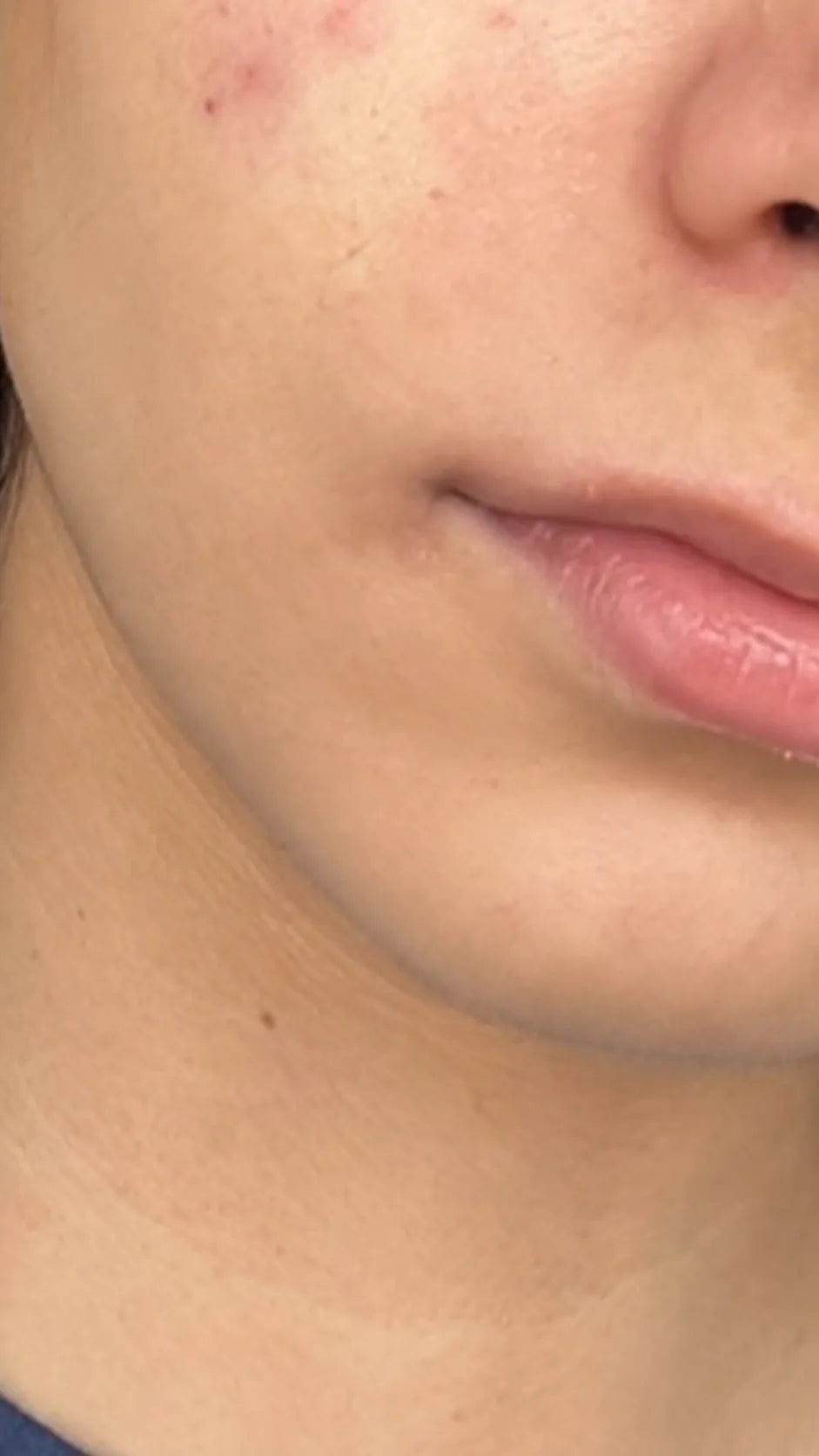 User-submitted before view of lower-face skin appearance.