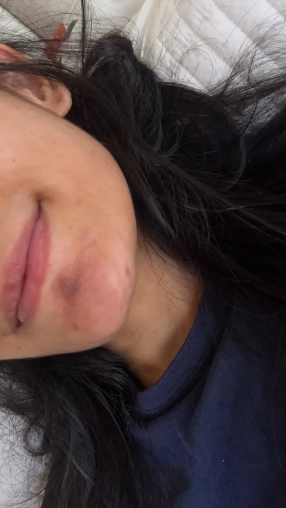 User-submitted before view of cheek skin appearance.